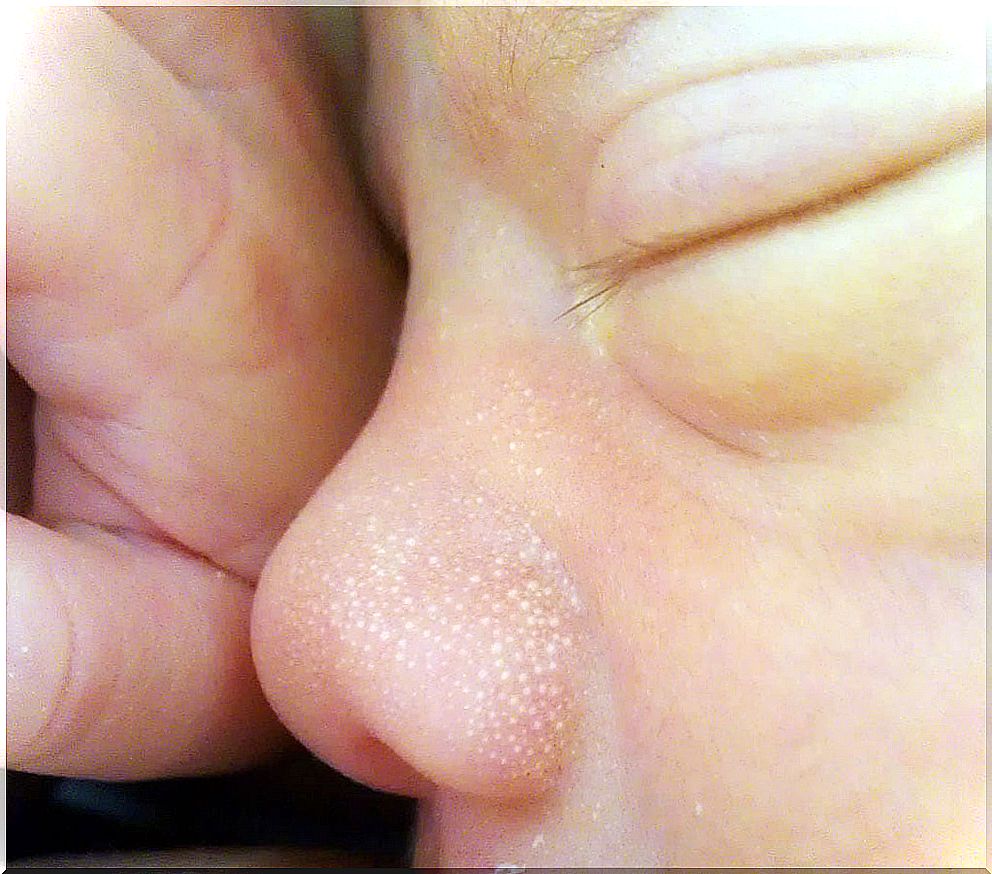 newborn_milia_milk_spots