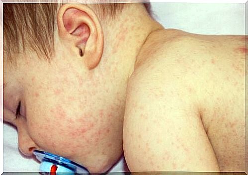 Do you know childhood scarlet fever?