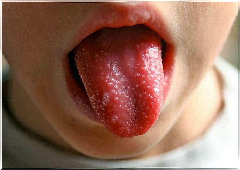 Tongue showing scarlet fever.