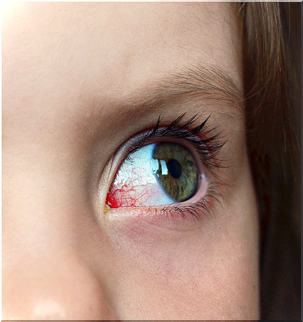 Child with red and inflamed eye as a symptom of possible childhood glaucoma.