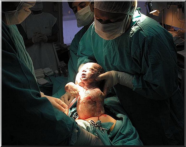 The evolutionary effect of cesarean section on the female body