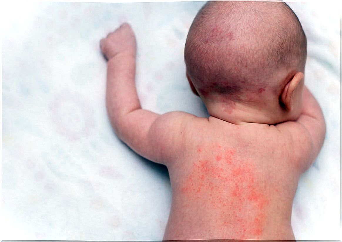 Back of a baby with sweat.